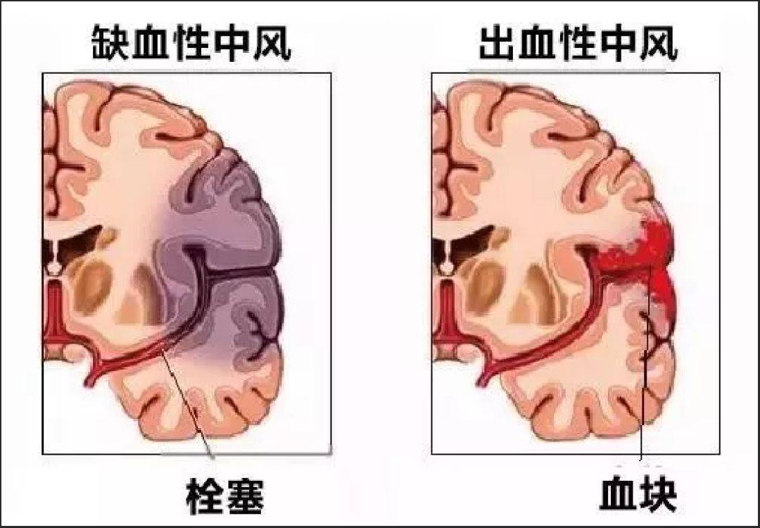 会不会突发脑瘤：脑瘤发生概率 